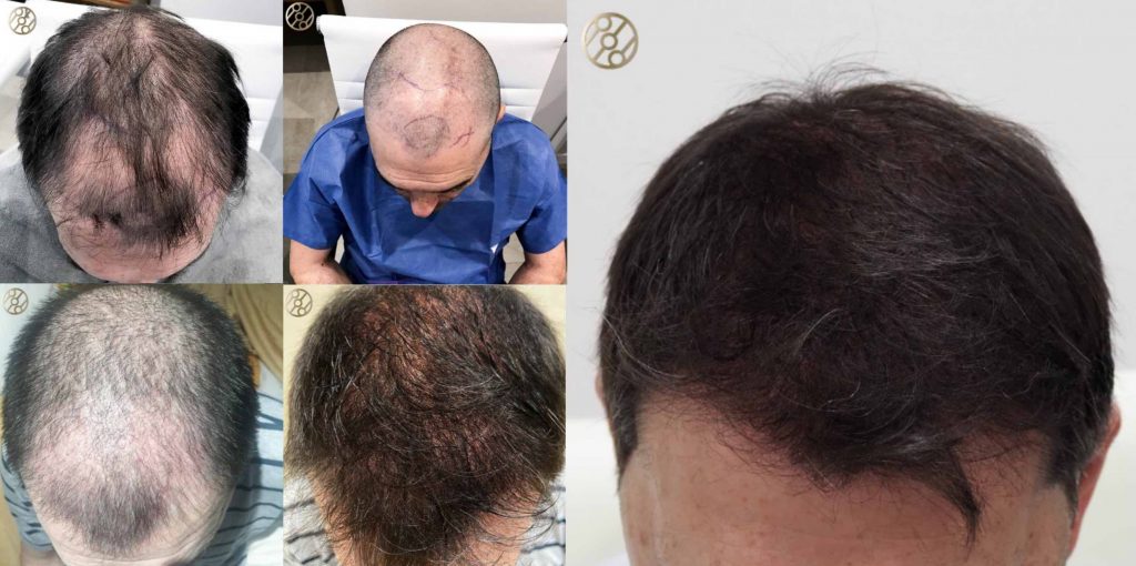 hair implant madrid before and after