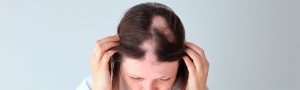 causa alopecia areata