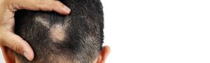 Alopecia areata