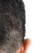 Alopecia areata, discover the best treatment