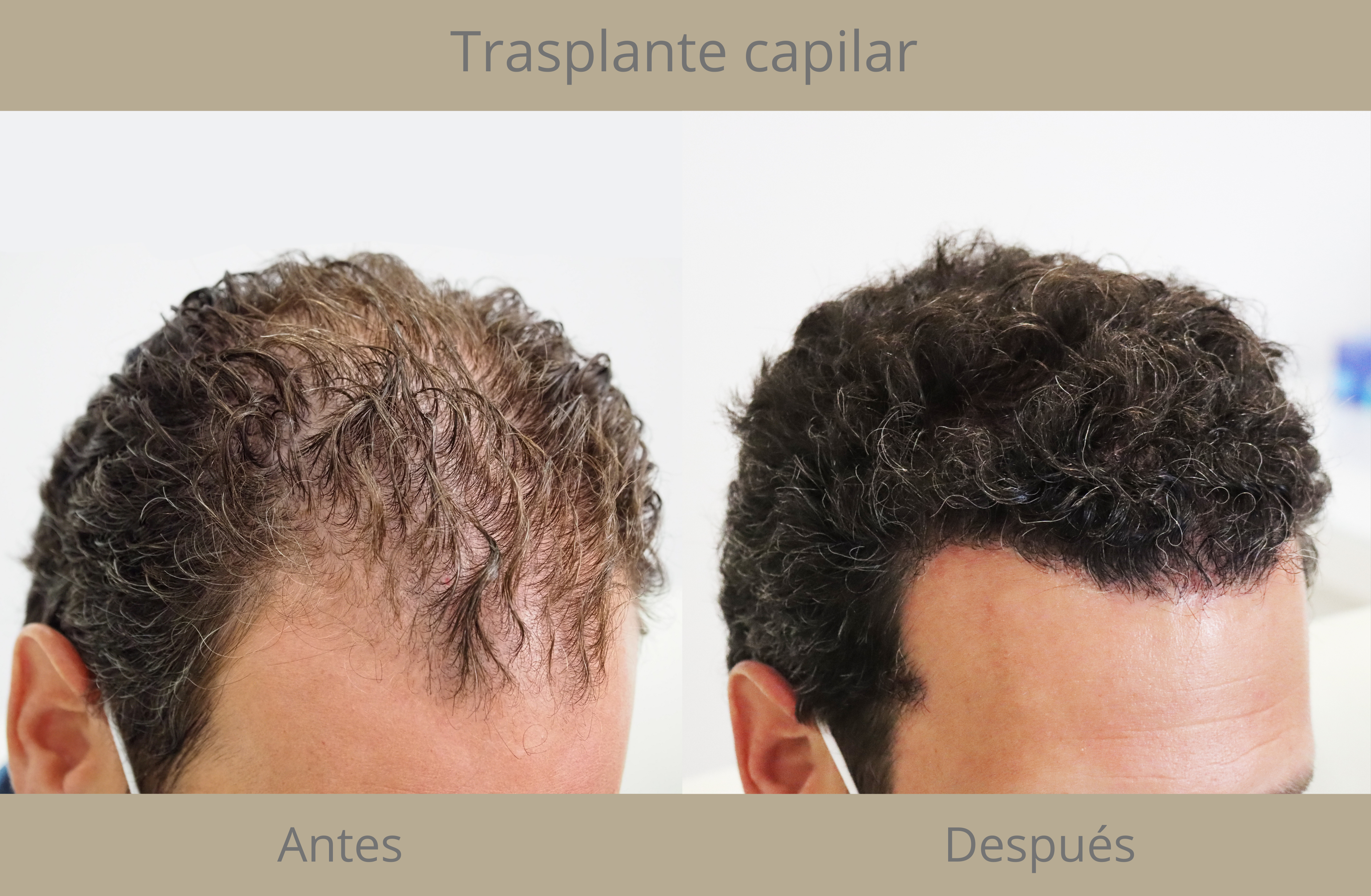 alopecia androgenética Instituto Médico del Prado