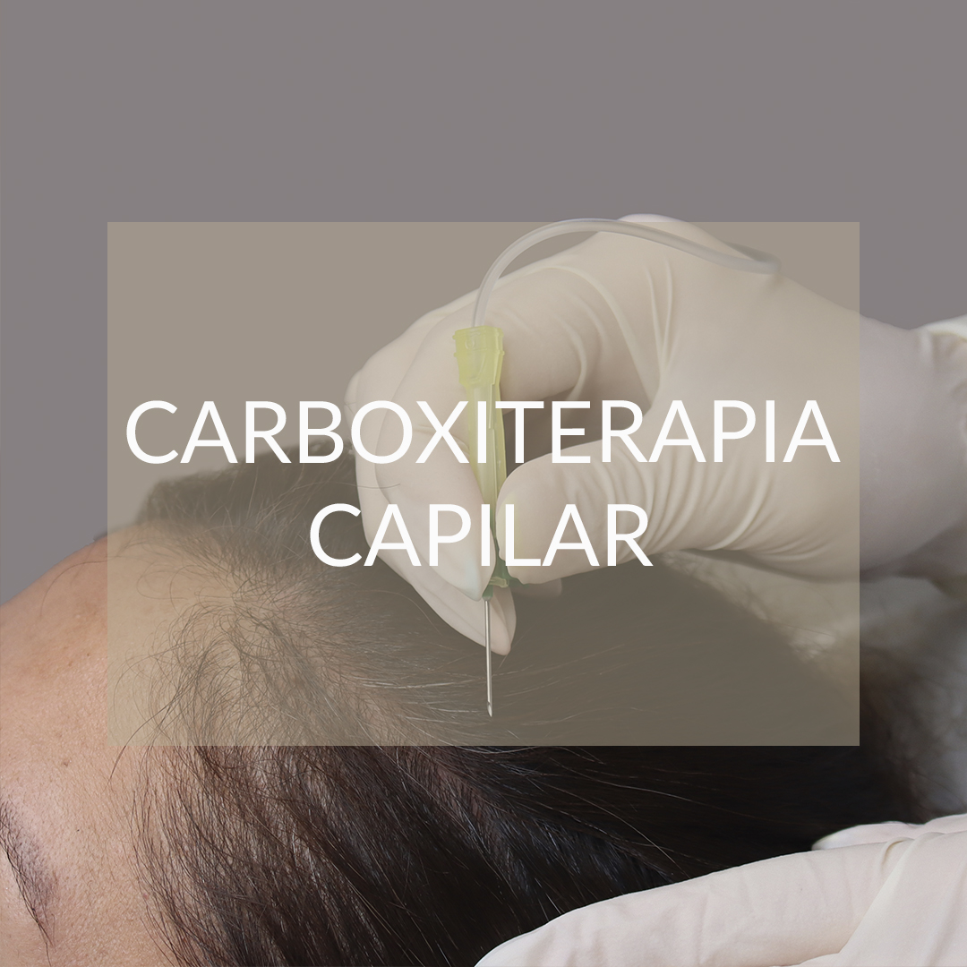 carboxiterapia capilar madrid