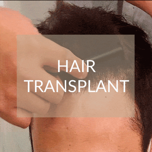 hair transplant madrid