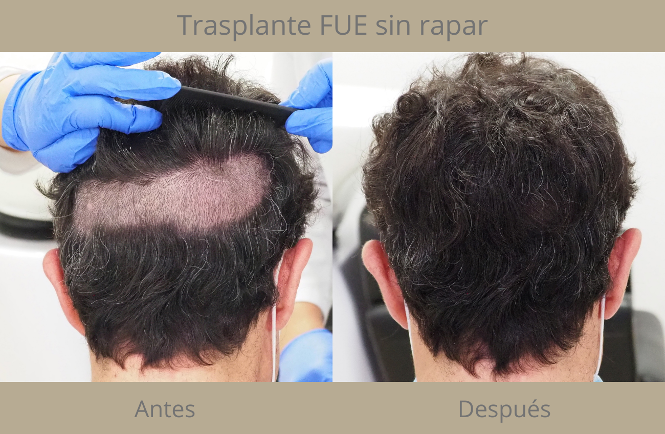 Non-shaving capillary transplant in Madrid - Instituto Médico del Prado