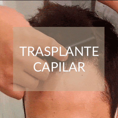 trasplante capilar madrid