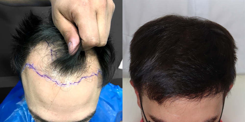 antes y después trasplante capilar