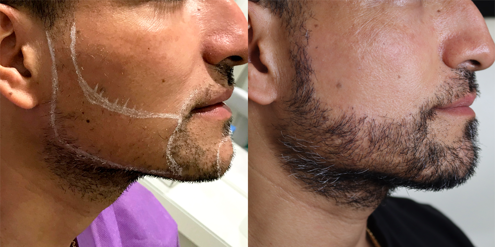 antes y después trasplante barba madrid