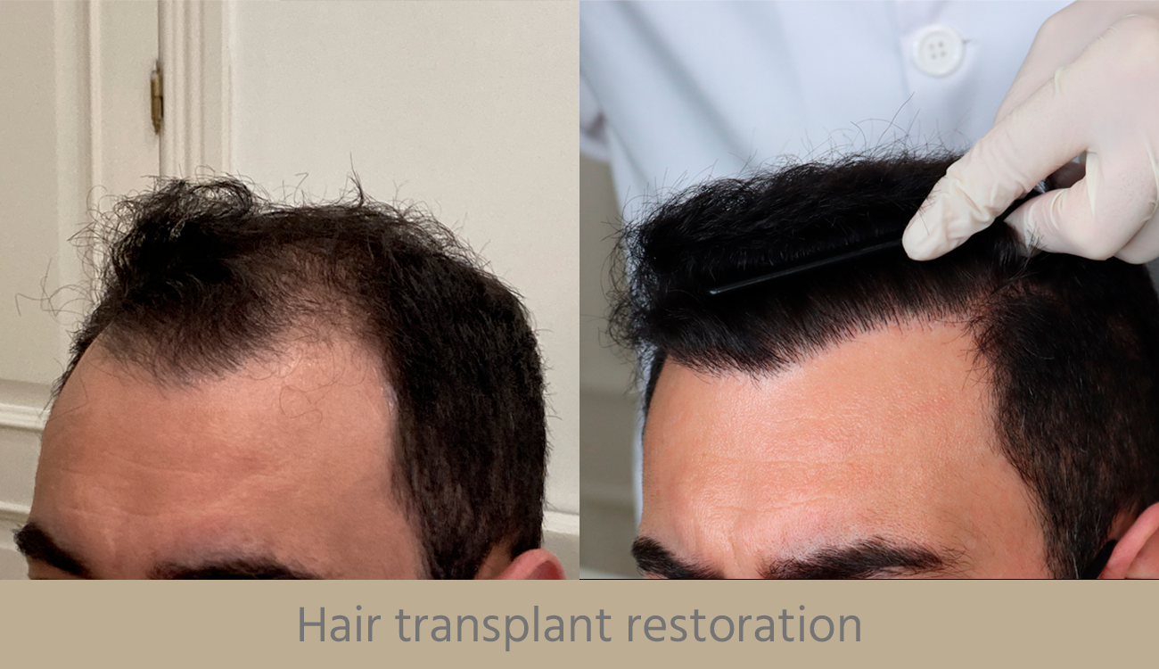 hair transplant restoration