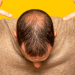 Alopecia difusa: cómo tratarla
