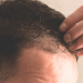Folliculitis: how to prevent it