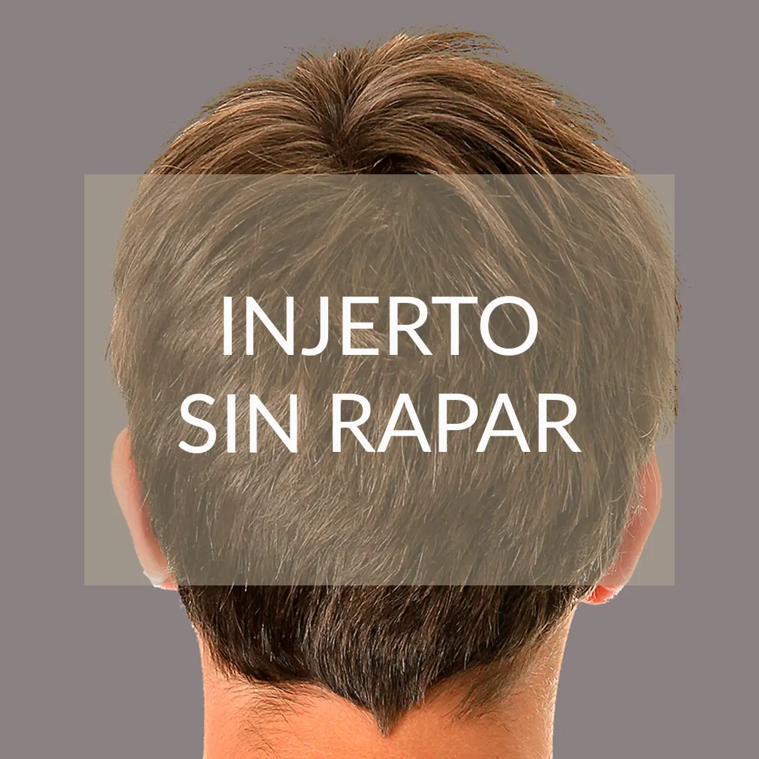 Injerto capilar sin rapar técnica DHI