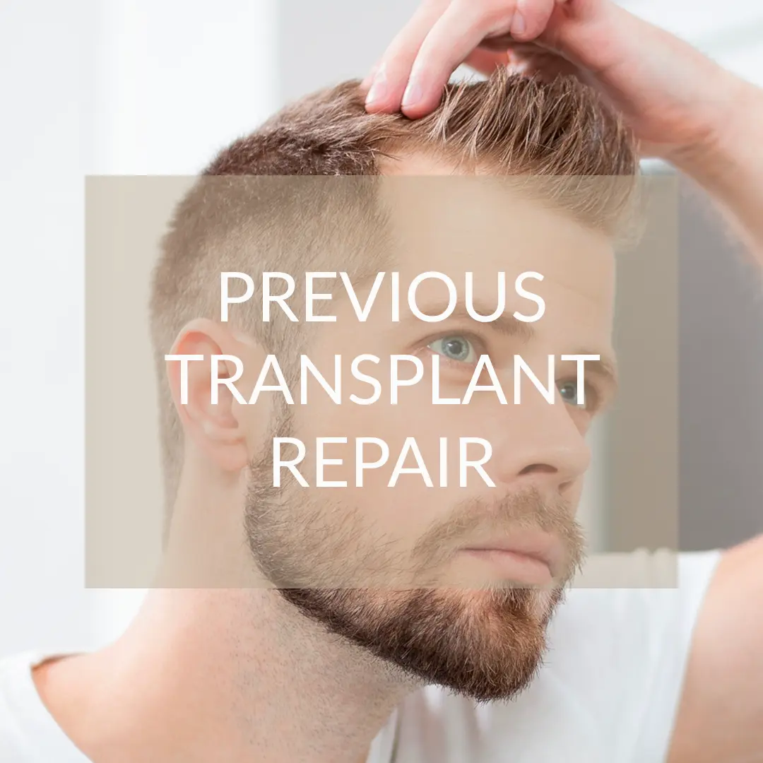 Restoration of previous hair transplant