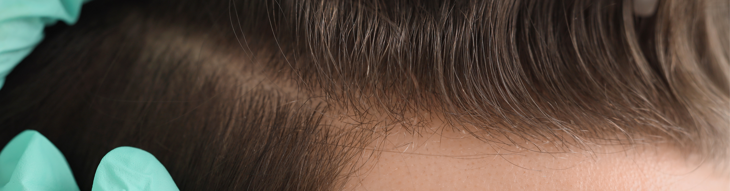 Primera línea trasplante capilar